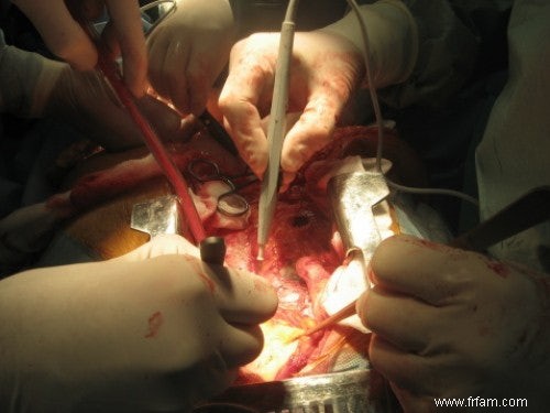 Un nouveau stent empêche la déchirure de l artère dans l arc aortique 