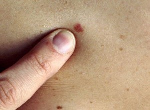 Une nouvelle piste pour le traitement du cancer de la peau 