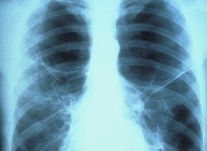 Le cancer du poumon en hausse chez les non-fumeurs 