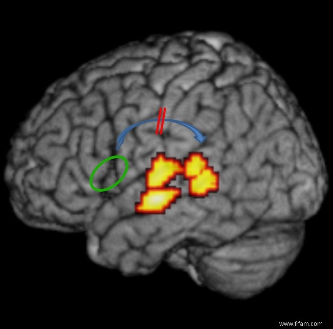 Les connexions cérébrales perturbées provoquent la dyslexie 