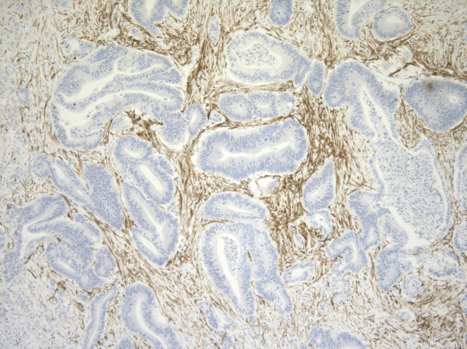 Les complices de la tumeur démasqués 