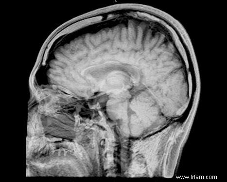 Les erreurs génétiques annoncent la schizophrénie 