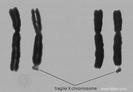 Un mécanisme à l origine de l autisme, de la schizophrénie et de la maladie d Alzheimer 