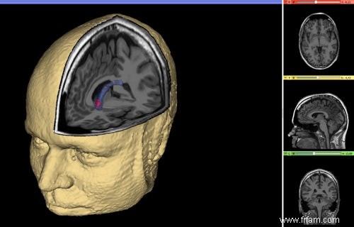 Le noyau cérébral garde les insomniaques éveillés 