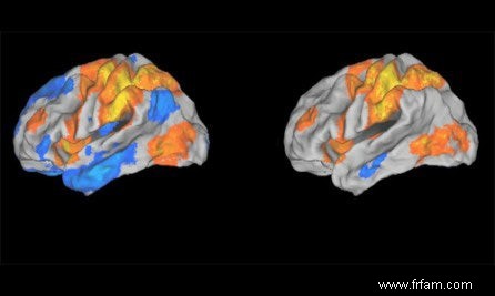 La douleur chronique modifie le cerveau 