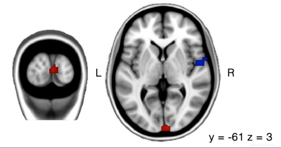 Le syndrome du supermarché :qu est-ce que c est et que fait-il à notre cerveau ? 