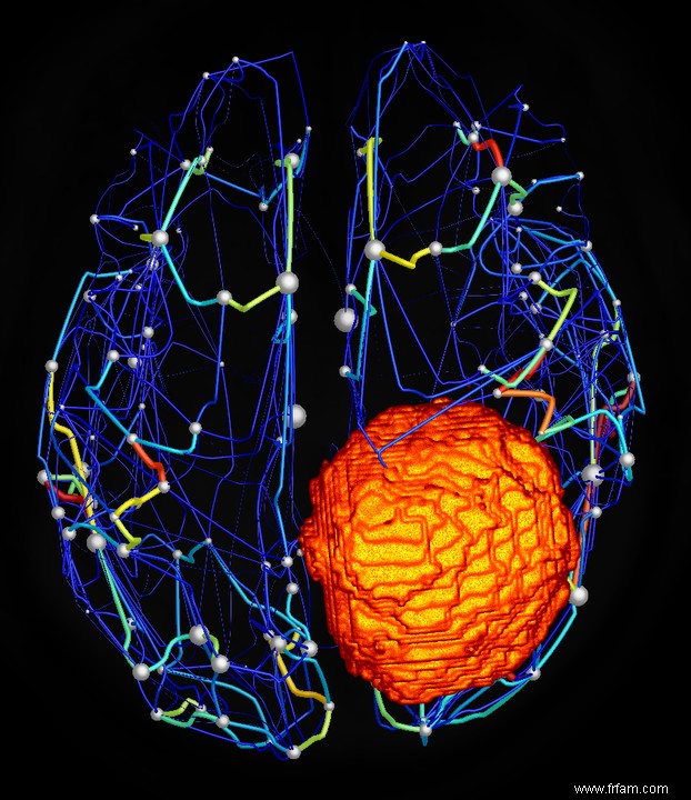 Le cerveau virtuel d un patient atteint d une tumeur cérébrale améliore la chirurgie 