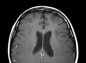 La couche protectrice dans le cerveau trahit la démence 