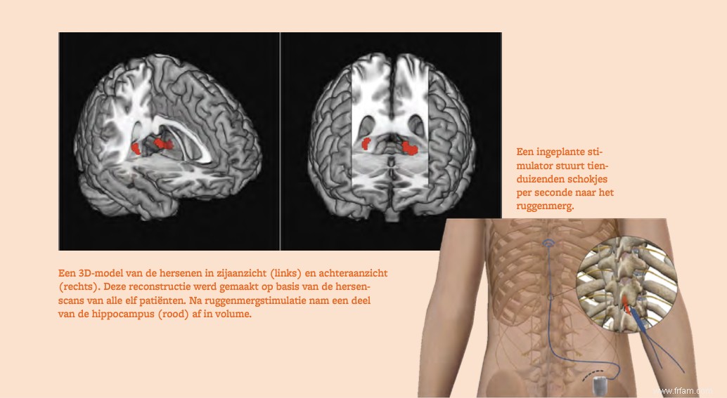 Le cerveau comme médicament contre le mal de dos 