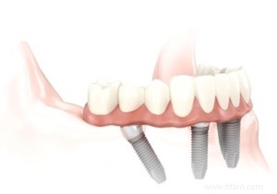 Différents types d implants dentaires et comment en choisir un en fonction de la santé de votre mâchoire 